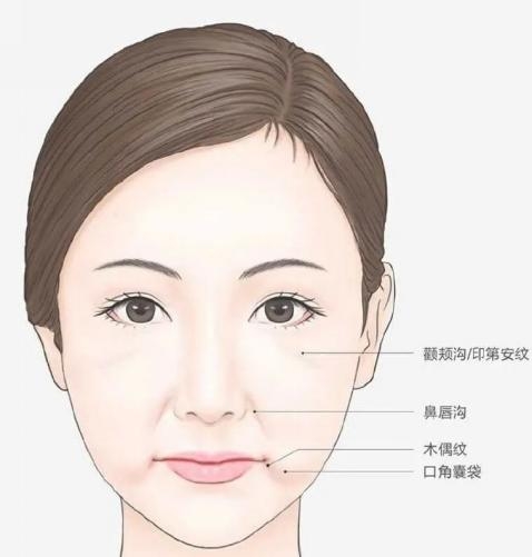 米揚麗格馬平山醫(yī)生采用PLLA艾維嵐在口周年輕化方面的成果(圖6)