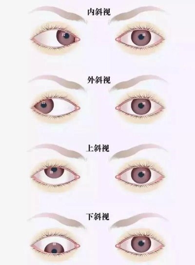 愛(ài)爾眼科：總愛(ài)偏頭看，視力“一好一壞”？警惕斜視！