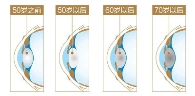 愛爾眼科：白內(nèi)障不會(huì)“缺席”只會(huì)“遲到”？(圖6)