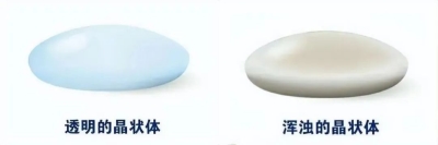 愛爾眼科：白內(nèi)障不會(huì)“缺席”只會(huì)“遲到”？(圖3)