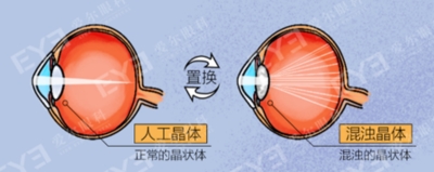 愛爾眼科：白內(nèi)障不會(huì)“缺席”只會(huì)“遲到”？(圖4)